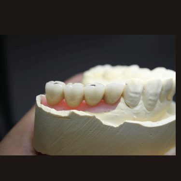 Screw Retained Ti